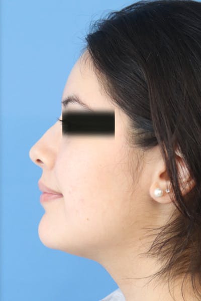 Liquid Rhinoplasty Before & After Gallery - Patient 152434122 - Image 4