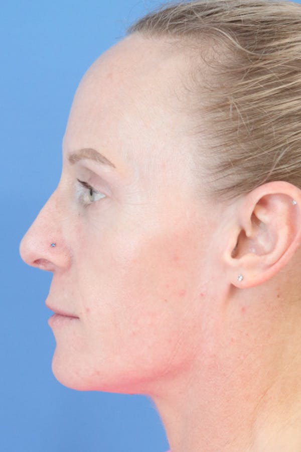 Liquid Rhinoplasty Before & After Gallery - Patient 152434124 - Image 3