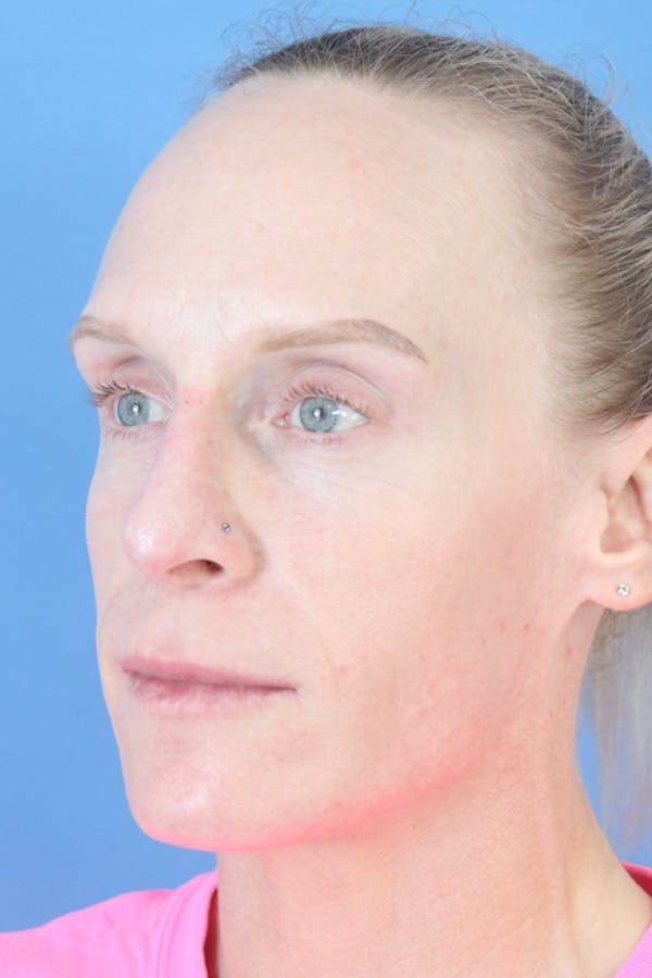 Liquid Rhinoplasty Before & After Gallery - Patient 152434124 - Image 2