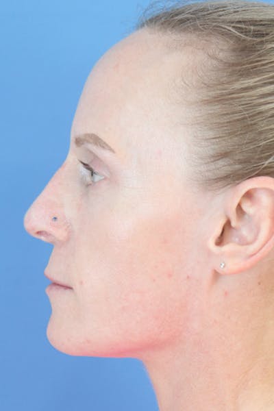 Liquid Rhinoplasty Before & After Gallery - Patient 152434124 - Image 4