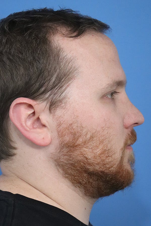 Rhinoplasty Before & After Gallery - Patient 152434127 - Image 3