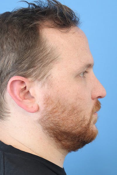 Rhinoplasty Before & After Gallery - Patient 152434127 - Image 4