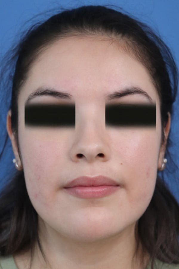 Buccal Fat Removal Before & After Gallery - Patient 152434126 - Image 1
