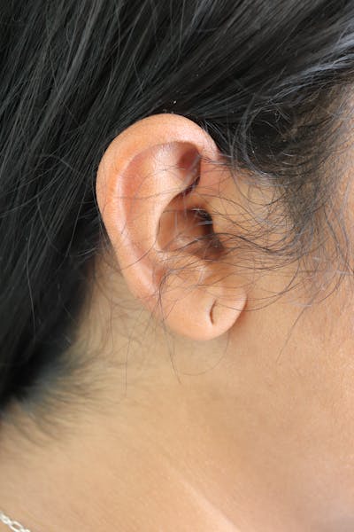 Earlobe Repair Before & After Gallery - Patient 346832 - Image 1