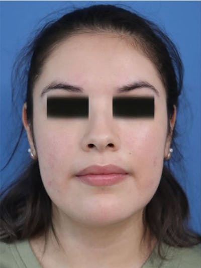 Buccal Fat Removal Before & After Gallery - Patient 311669 - Image 1