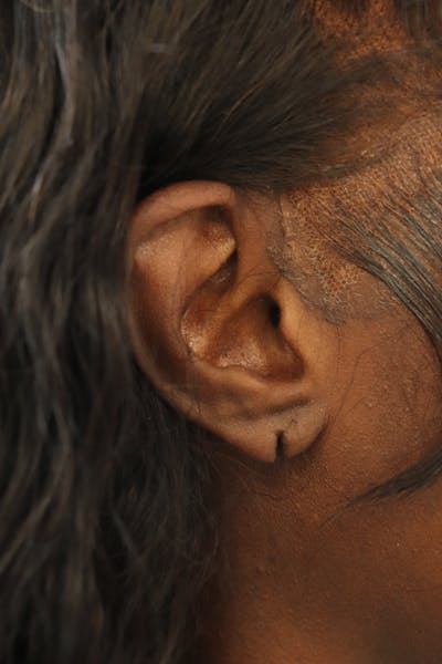 Earlobe Repair Before & After Gallery - Patient 378428 - Image 1