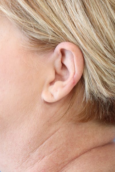 Earlobe Repair Before & After Gallery - Patient 373343 - Image 1