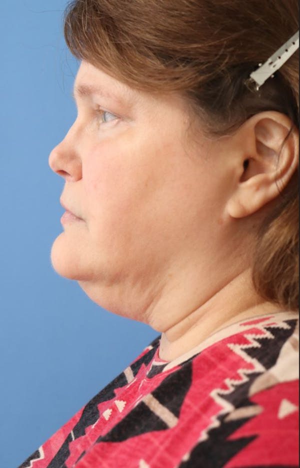 Facelift Before & After Gallery - Patient 203107 - Image 1