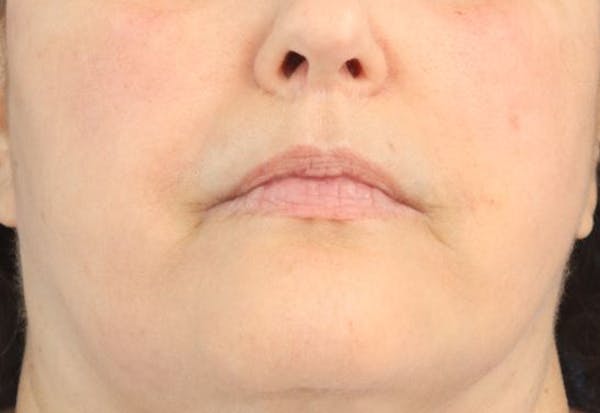 Lip Filler Before & After Gallery - Patient 174494 - Image 1