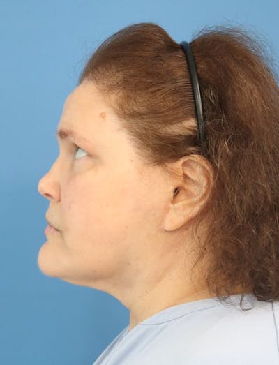 Liquid Rhinoplasty Before & After Gallery - Patient 379512 - Image 1