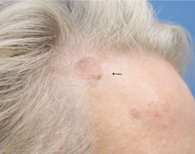 Mole Removal Before & After Gallery - Patient 182882 - Image 1