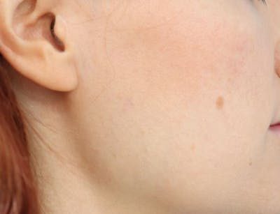 Mole Removal Before & After Gallery - Patient 286495 - Image 2