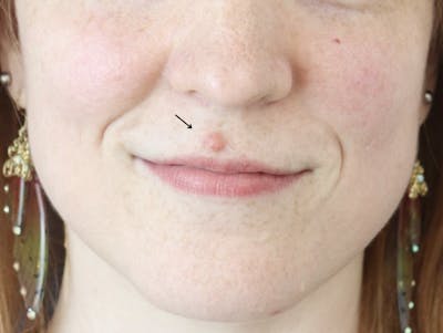 Mole Removal Before & After Gallery - Patient 180519 - Image 1