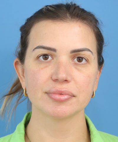 Cheek & Under Eye Filler Before & After Gallery - Patient 154584 - Image 1