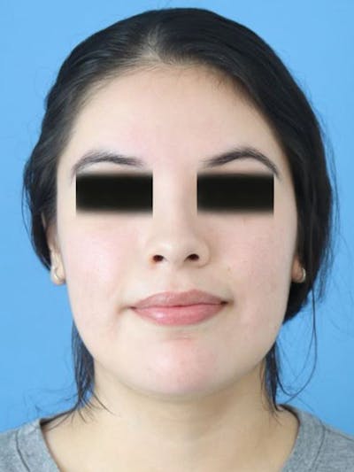 Buccal Fat Removal Before & After Gallery - Patient 311669 - Image 2