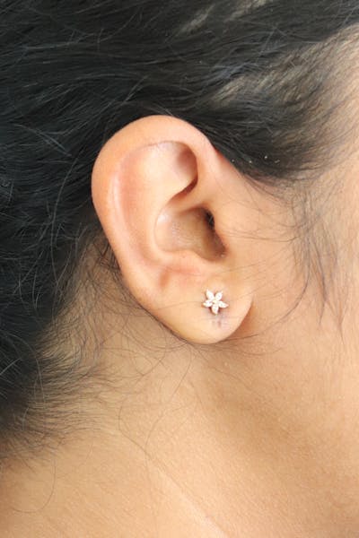 Earlobe Repair Before & After Gallery - Patient 346832 - Image 2