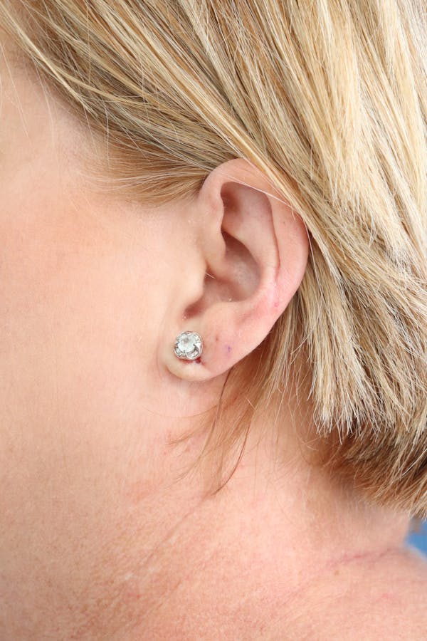 Earlobe Repair Before & After Gallery - Patient 373343 - Image 2