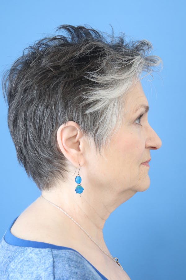 Facelift Before & After Gallery - Patient 418529 - Image 1
