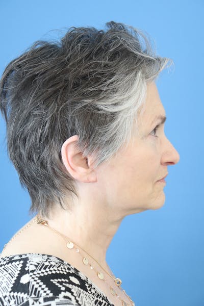 Facelift Before & After Gallery - Patient 418529 - Image 2
