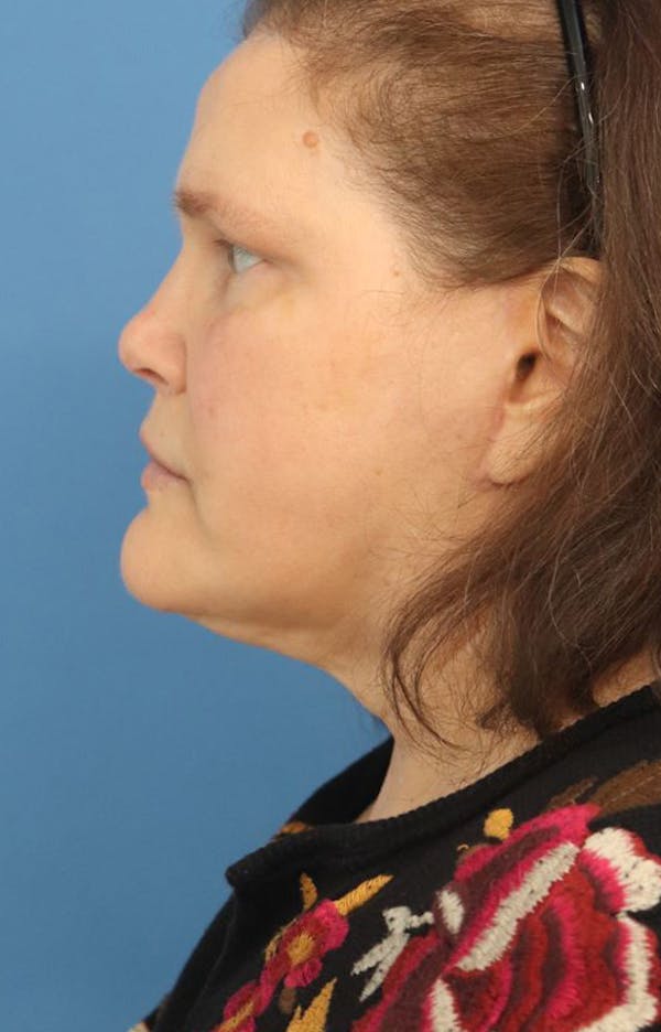 Facelift Before & After Gallery - Patient 203107 - Image 2