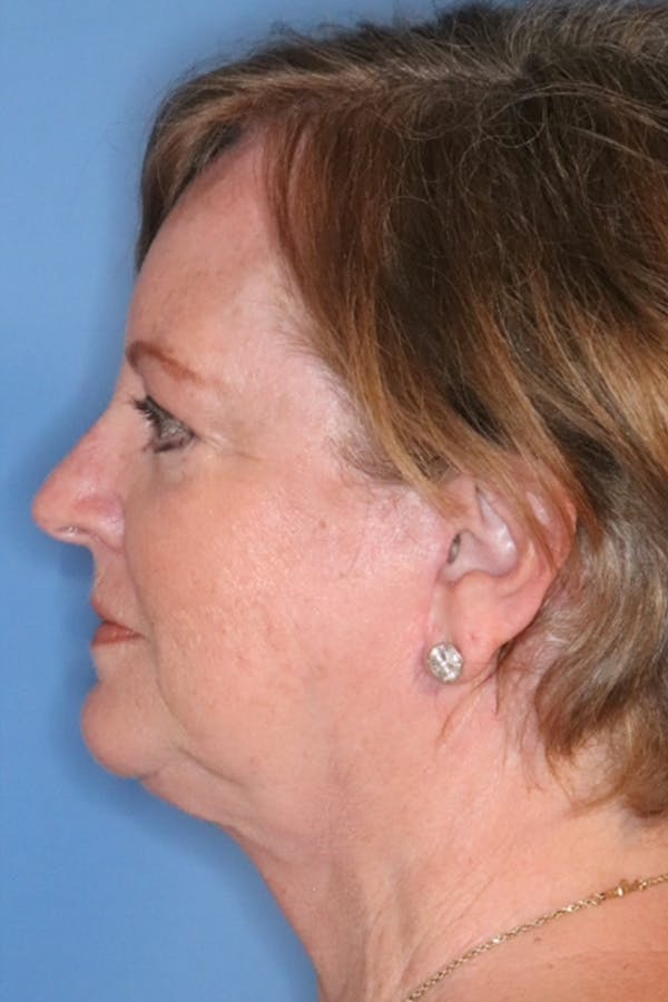 Facelift Before & After Gallery - Patient 886458 - Image 2