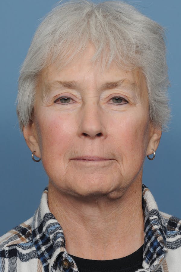 Facelift Before & After Gallery - Patient 362650 - Image 1