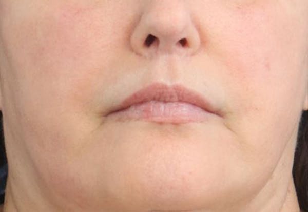 Lip Filler Before & After Gallery - Patient 174494 - Image 2