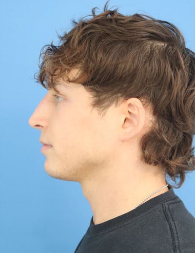 Liquid Rhinoplasty Before & After Gallery - Patient 218705 - Image 2