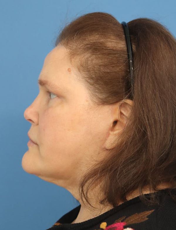 Liquid Rhinoplasty Before & After Gallery - Patient 379512 - Image 2