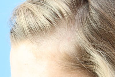 Mole Removal Before & After Gallery - Patient 323841 - Image 2
