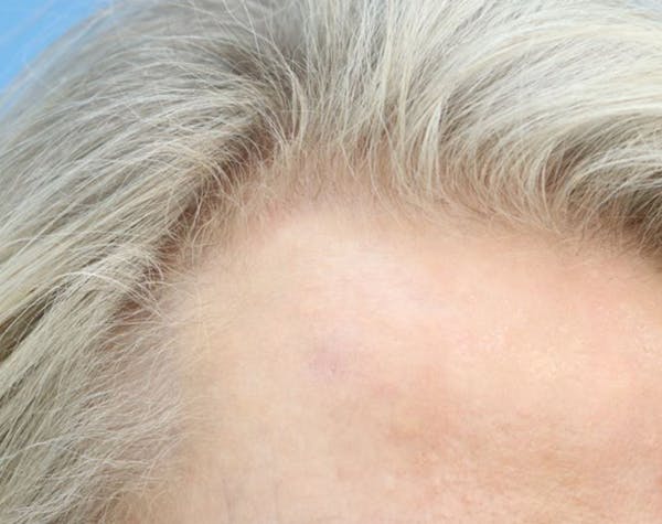 Mole Removal Before & After Gallery - Patient 182882 - Image 2