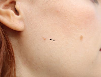 Mole Removal Before & After Gallery - Patient 286495 - Image 1