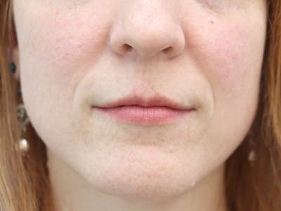Mole Removal Before & After Gallery - Patient 180519 - Image 2