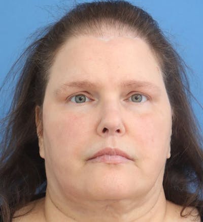 Cheek & Under Eye Filler Before & After Gallery - Patient 118952 - Image 2