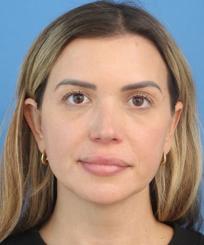 Cheek & Under Eye Filler Before & After Gallery - Patient 154584 - Image 2