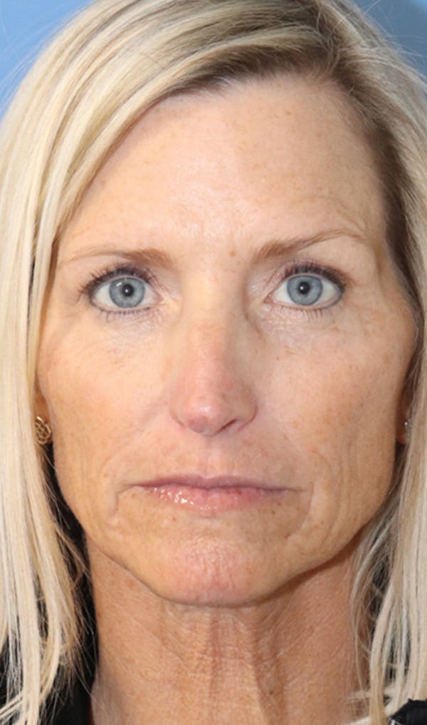 Cheek & Under Eye Filler Before & After Gallery - Patient 144976917 - Image 2