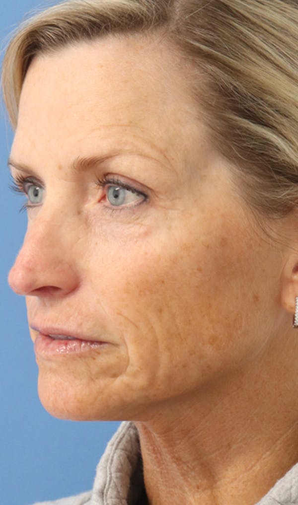 Cheek & Under Eye Filler Before & After Gallery - Patient 144976917 - Image 3