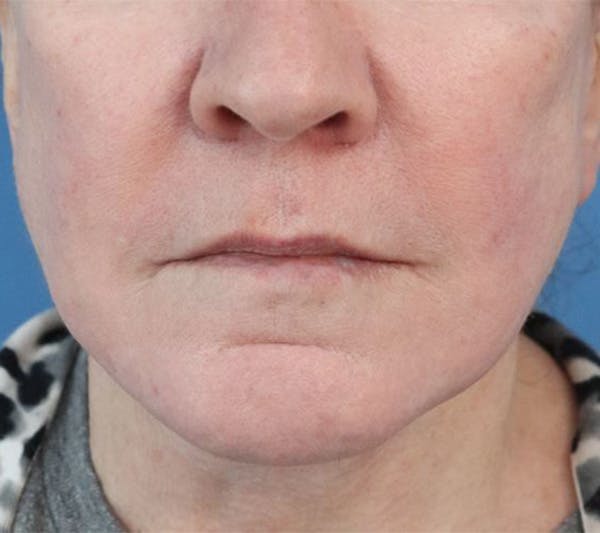 Lip Lift Before & After Gallery - Patient 427234 - Image 3