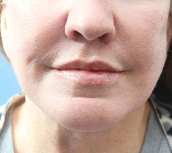 Lip Lift Before & After Gallery - Patient 427234 - Image 4