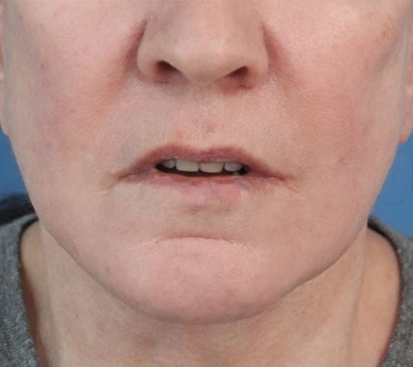 Lip Lift Before & After Gallery - Patient 427234 - Image 1