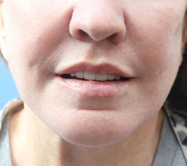 Lip Lift Before & After Gallery - Patient 427234 - Image 2