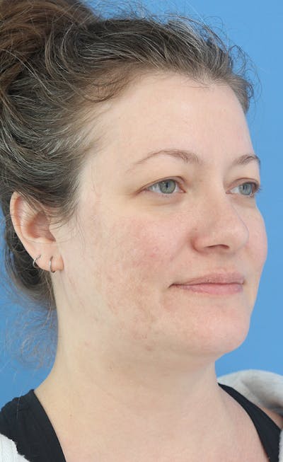 FaceTite Before & After Gallery - Patient 289760 - Image 2