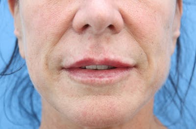 Lip Filler Before & After Gallery - Patient 912540 - Image 2