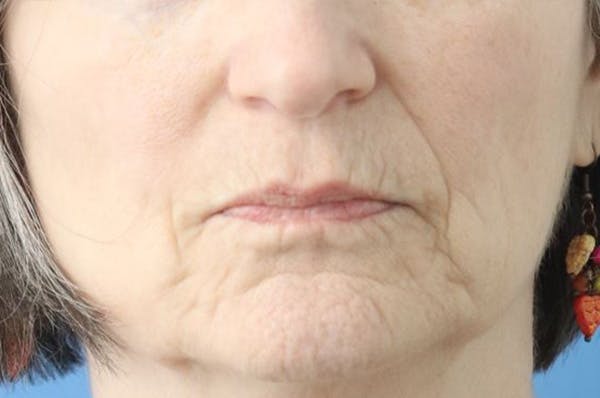 Lip Lift Before & After Gallery - Patient 316053 - Image 1