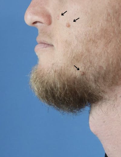 Mole Removal Before & After Gallery - Patient 420028 - Image 1