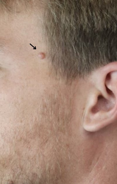 Mole Removal Before & After Gallery - Patient 342436 - Image 1