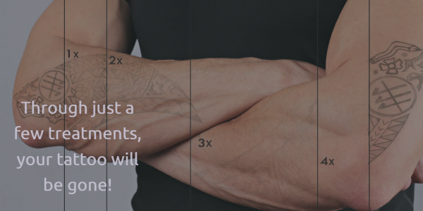 PicoSure Laser Tattoo Removal | Manhattan | Woodside, NYC PicoSure Laser Tattoo Removal | Manhattan | Woodside, NYC