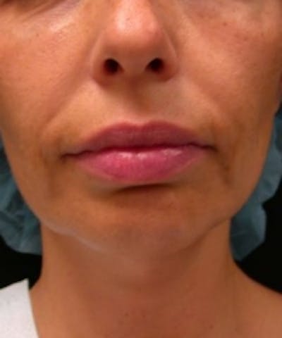 Facial Rejuvenation Before & After Gallery - Patient 5930054 - Image 1