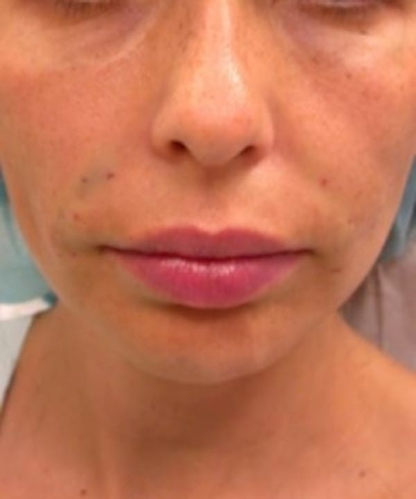 Facial Rejuvenation Before & After Gallery - Patient 5930054 - Image 2