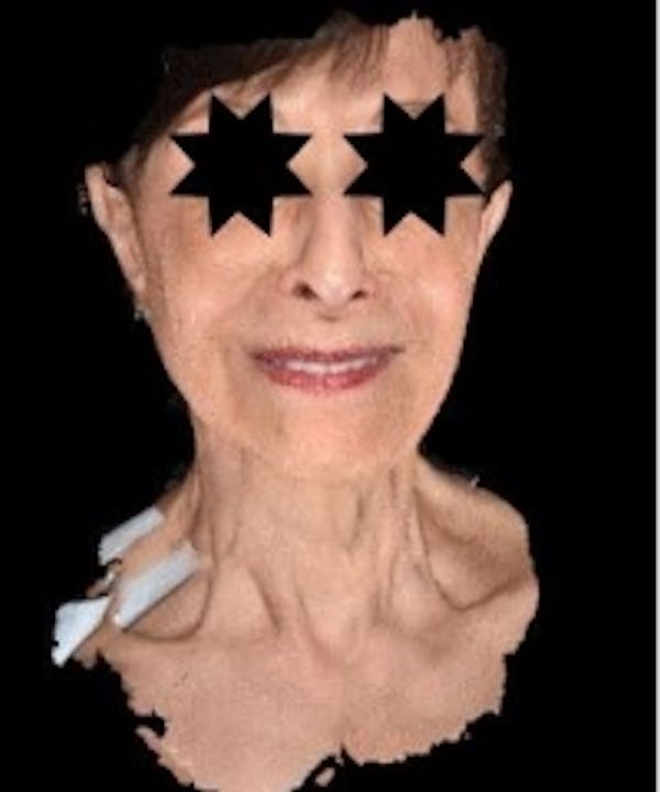 Facial Rejuvenation Gallery - Patient 5930055 - Image 1
